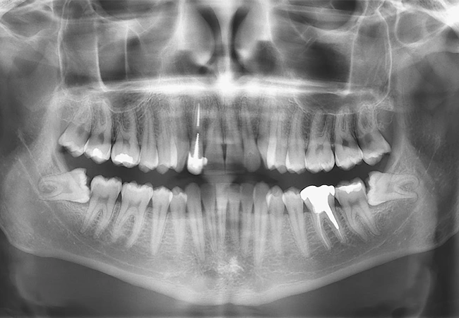 Radiografía panoramica terceras molares
